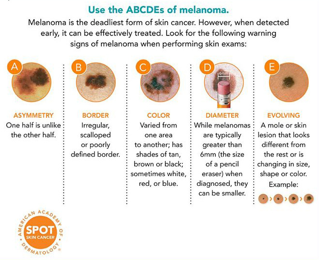 Use the ABCDEs of melanoma